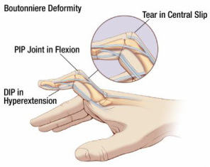 What Happens When a Basketball Hits Your Finger?